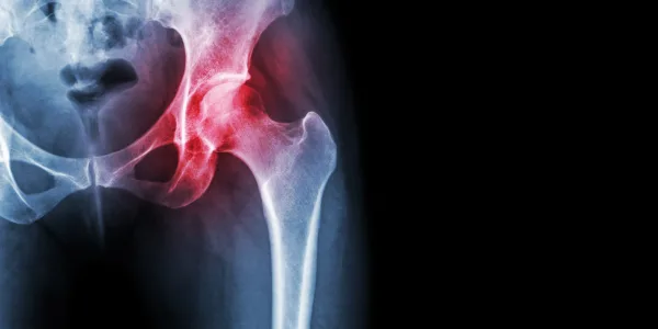 Injured Patients Seek Relief in Stryker Hip Litigation